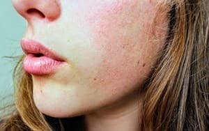 15 Amazing Benefits Of Guava Oil For Skin